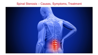 Dushyant Verma Shillong - Spinal Stenosis – Causes, Symptoms, Treatment Digital slide making software